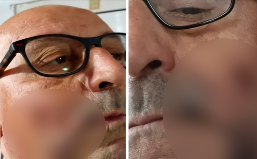Ξάνθη: Θύμα ξυλοδαρμού ο πρόεδρος του Συλλόγου Πομάκων – «Υποψιάζομαι ανθρώπους του Ερντογάν»