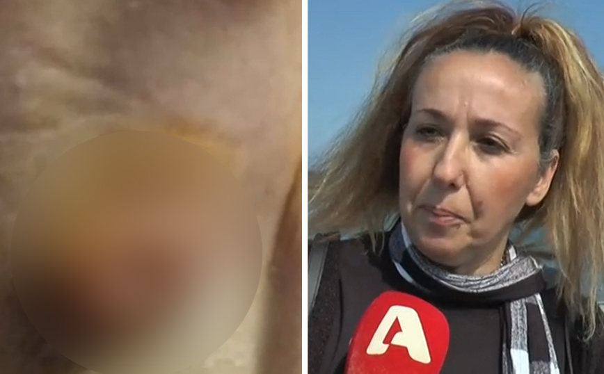 Πήγε σε κέντρο αισθητικής για αποτρίχωση στη μασχάλη και κατέληξε με οζίδια στο χειρουργείο – «Δεν έκλεινα τα χέρια μου»