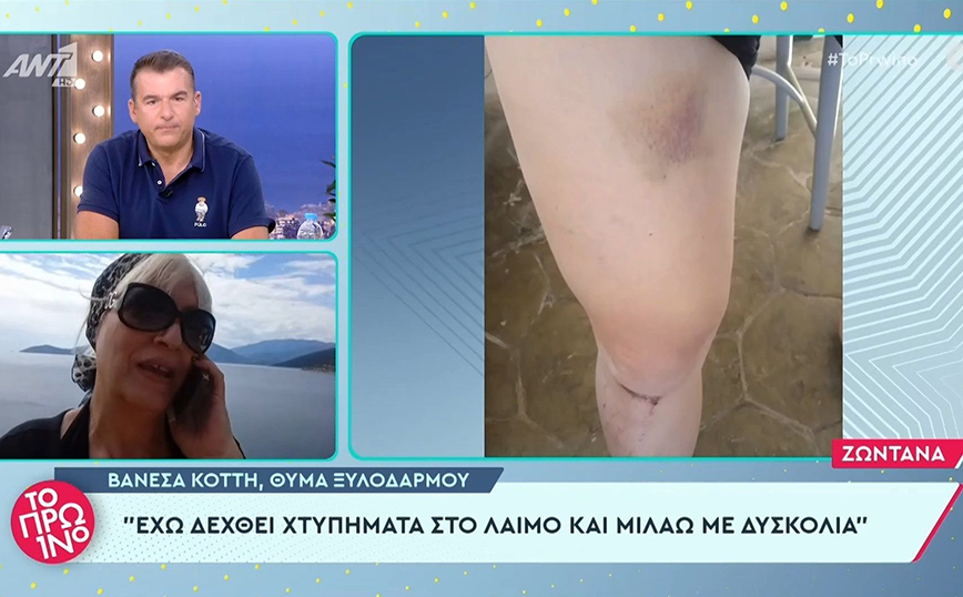 Θύμα άγριου ξυλοδαρμού έπεσε η τρανς ακτιβίστρια Βανέσα Βενέτη – «Με χτύπησαν στο λαιμό, μιλάω με δυσκολία»