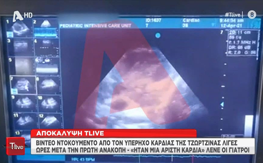 Ρούλα Πισπιρίγκου: Βίντεο – ντοκουμέντο με τον υπέρηχο της καρδιάς της Τζωρτζίνας αμέσως μετά την πρώτη ανακοπή