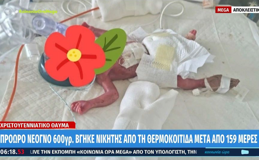 Μωράκι που γεννήθηκε πρόωρα στο νοσοκομείο του Ρίου και ζύγισε 600 γραμμάρια βγήκε νικητής μετά από 159 ημέρες