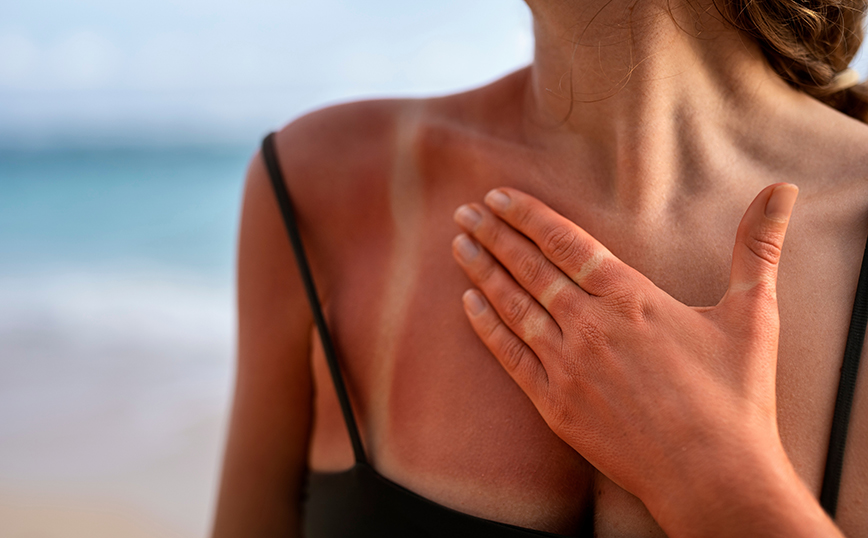 Γυναίκα έχει καεί από τον ήλιο Γυναίκα έχει καεί από τον ήλιο