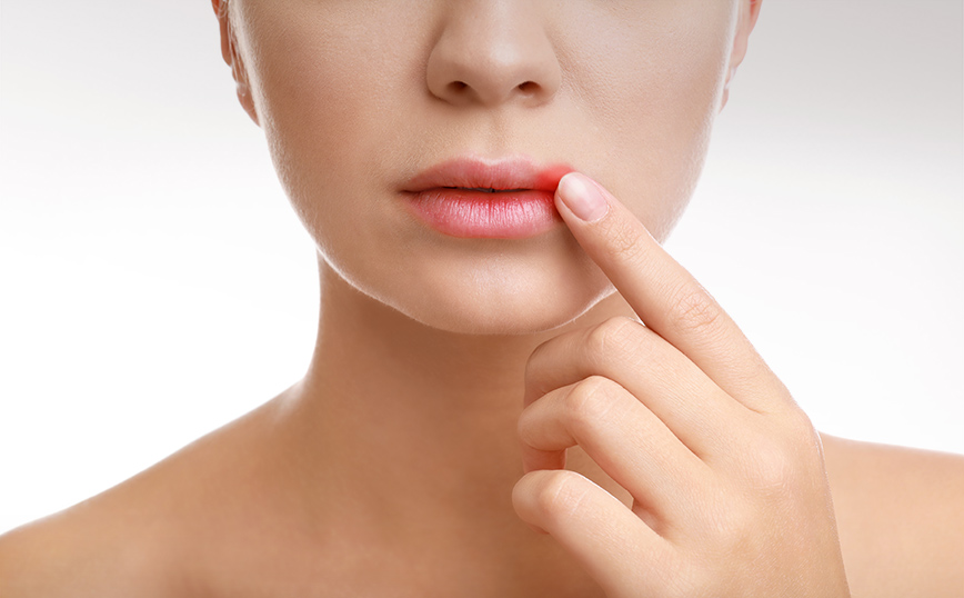 Επιχείλιος έρπης Επιχείλιος έρπης