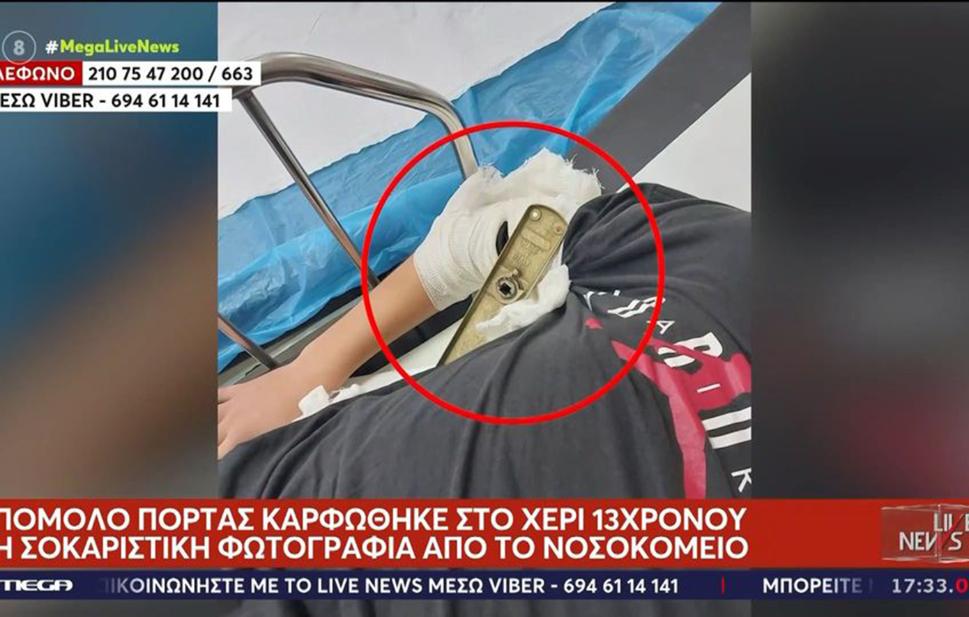 «Έτυχε ο νόμος του Μέρφυ»: Πώς καρφώθηκε πόμολο στο μπράτσο μαθητή σε σχολείο του Βόλου – Έφτασε δίπλα στο κόκκαλο