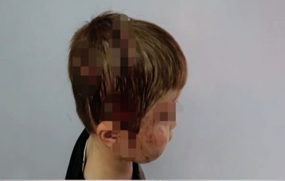 Πήγε να τον χαϊδέψει και του επιτέθηκε &#8211; Πώς ο σκύλος όρμησε στον 6χρονο και τον δάγκωσε στο κεφάλι