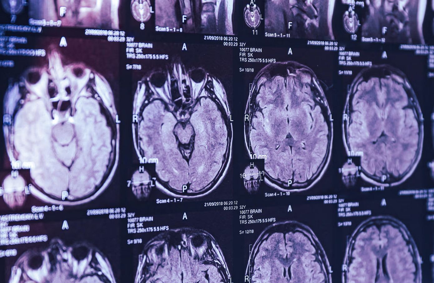 Συναγερμός στον Καναδά για εγκεφαλική νόσο που πλήττει νέους – Τι καταγγέλλει επιστήμονας που του απαγόρευσαν να την ερευνήσει
