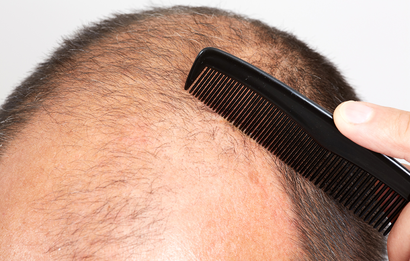 Τέλος η φαλάκρα; Ορός-«θαύμα» φέρνει τα πάνω κάτω στην ανάπτυξη μαλλιών