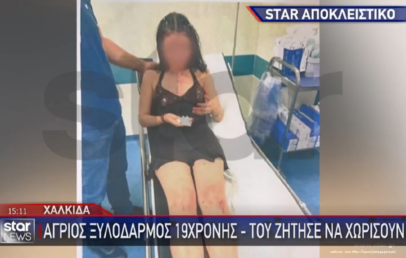 Αυτή είναι η 19χρονη που έπεσε θύμα άγριου ξυλοδαρμού από τον πρώην – «Την έκανε αγνώριστη»