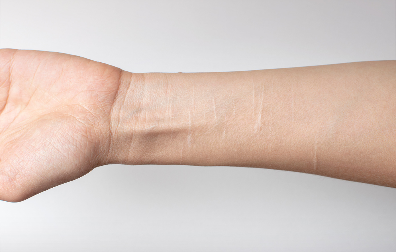 Αυτοτραυματισμός Αυτοτραυματισμός