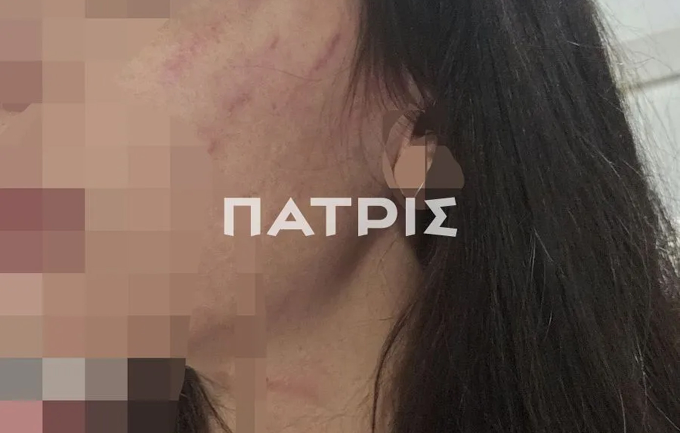 Έζησε ένα εφιαλτικό τριήμερο με τον σύντροφό της – «Την ξυλοκόπησε βάναυσα και την πέταξε στον δρόμο»
