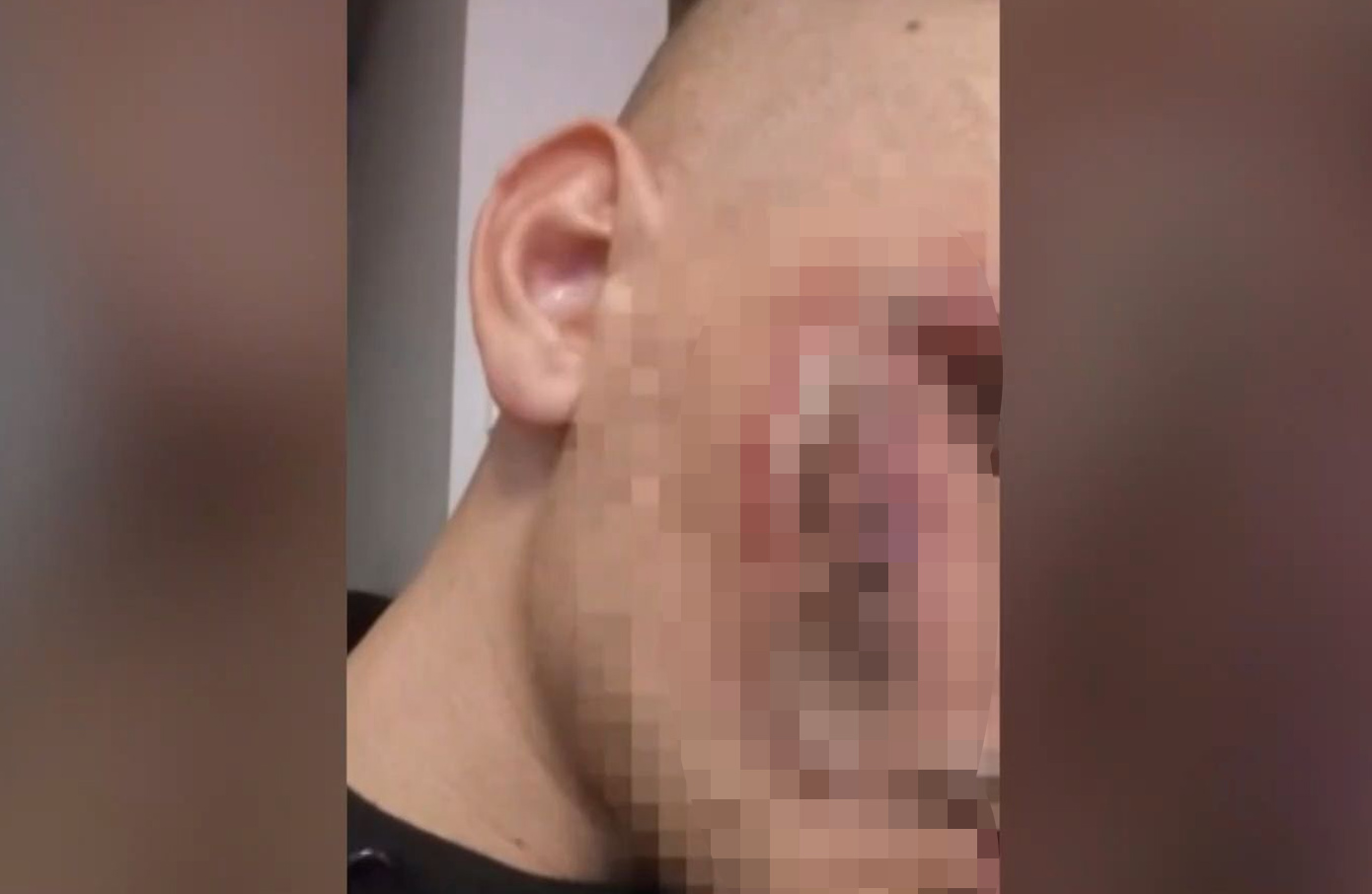 «Η μπαταρία πέταξε υγρά στο πρόσωπό μου» – Συγκλονίζει ο 24χρονος που τραυματίστηκε από την έκρηξη του κινητού του