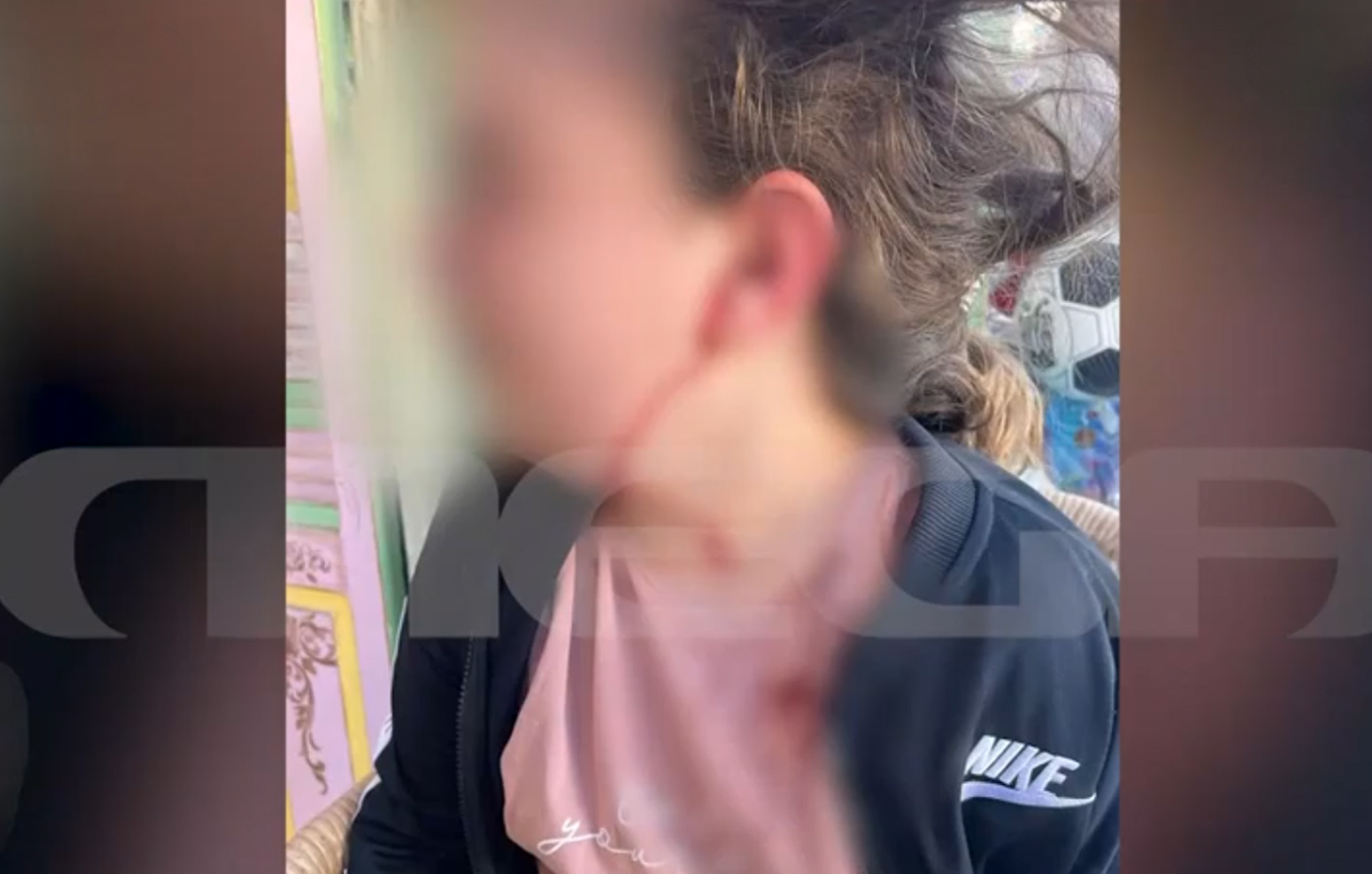 Πέλλα - Επίθεση σκύλου σε 10χρονη