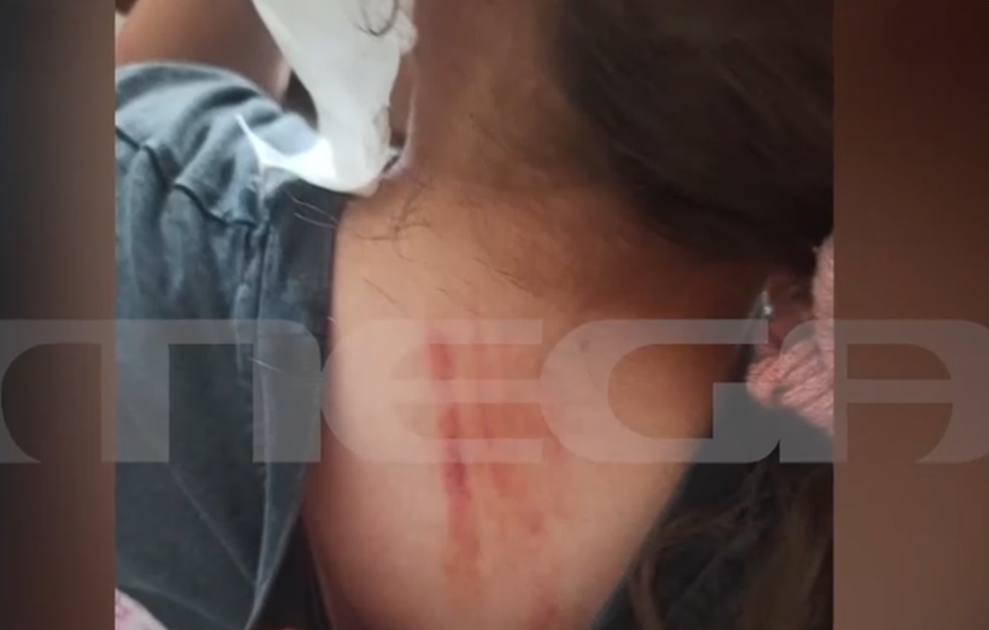 Φωτογραφίες ντοκουμέντο από την επίθεση σκύλου σε 10χρονη στην Πέλλα: «Της έσκισε το αυτί» λέει η μητέρα της