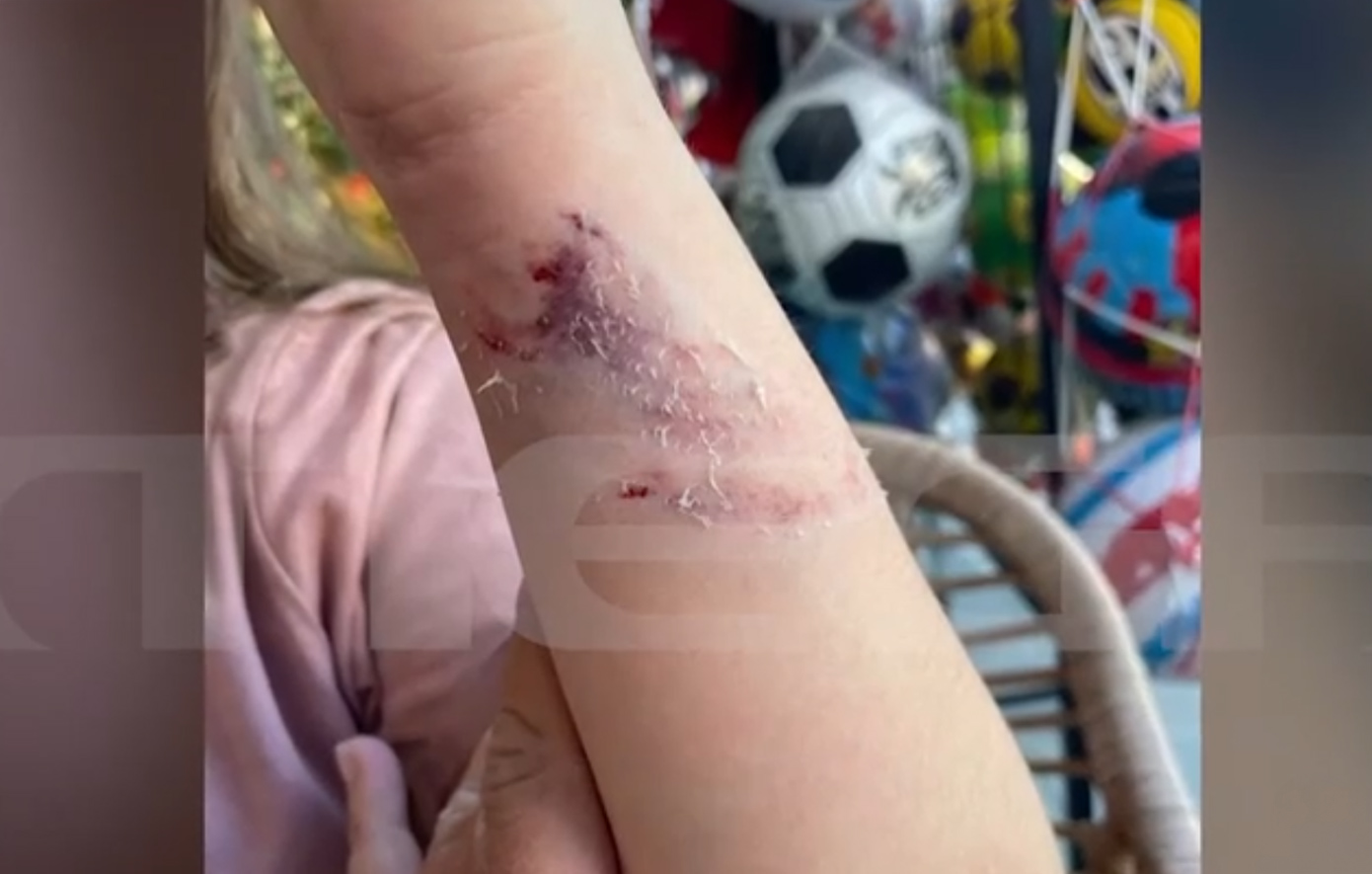 Πέλλα - Επίθεση σκύλου σε 10χρονη