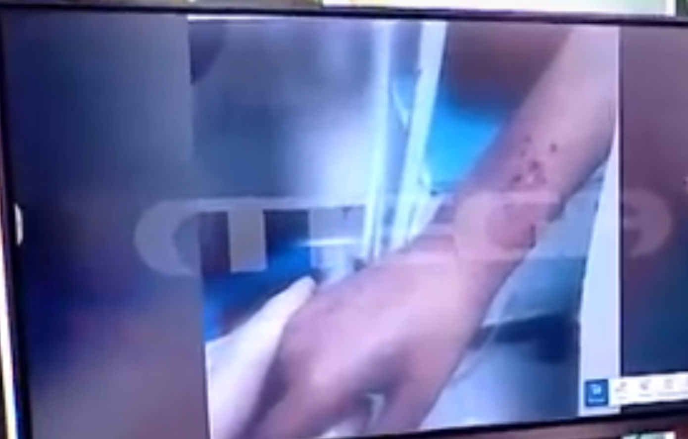 Ανατριχιαστικές εικόνες με τα αδερφάκια στη Λάρισα: Αυτές τις πληγές είδαν οι γιατροί και «πάγωσαν»