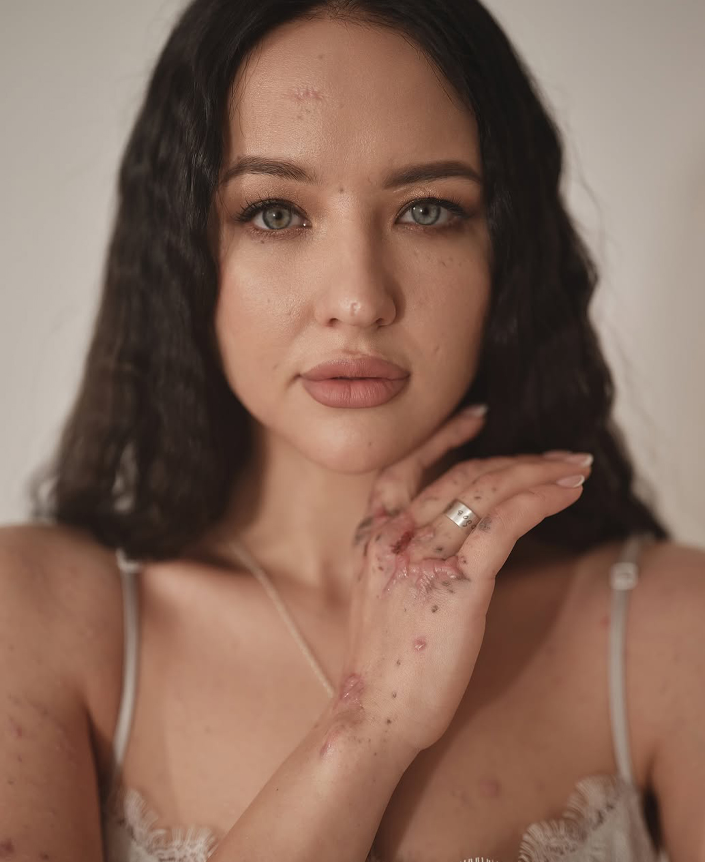 Ουκρανές τραυματίες πολέμου