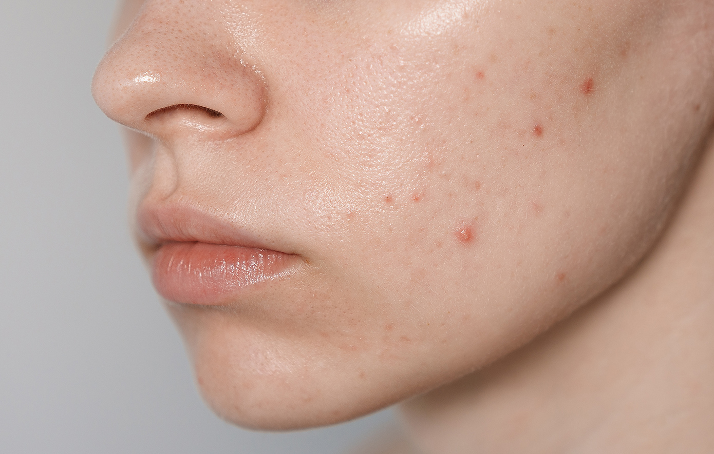 Γυναίκα με ακμή