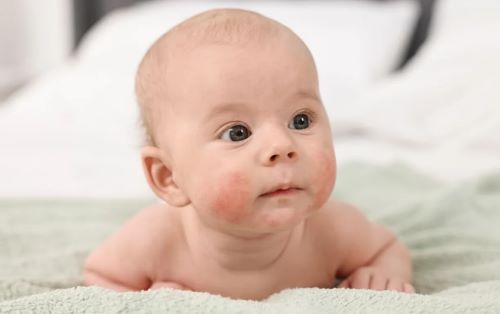 Αλλεργίες σε βρέφη: Ποια συμπτώματα χτυπούν «καμπανάκι» και τι λέει ο ειδικός