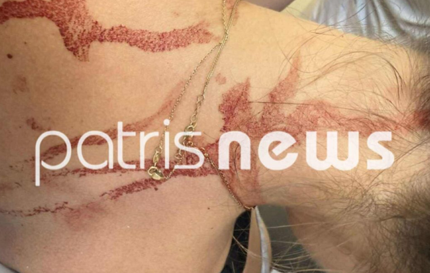 Άγρια συμπλοκή γυναικών στην Αμαλιάδα: Την κυνηγούσε με ψαλίδι στον δρόμο και της το κάρφωσε στην πλάτη
