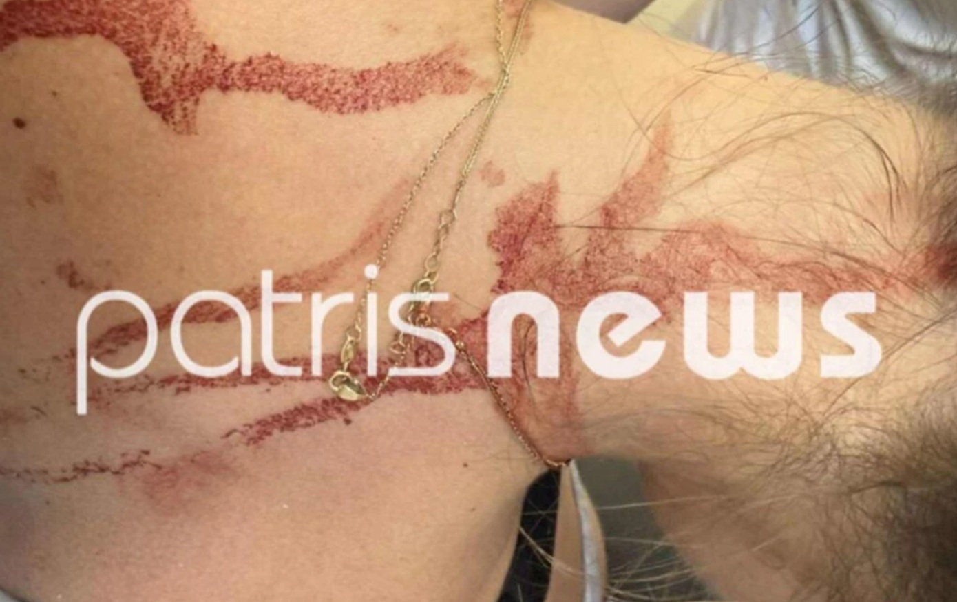 Στη φυλακή η 48χρονη που κάρφωσε γυναίκα με ψαλίδι στην πλάτη
