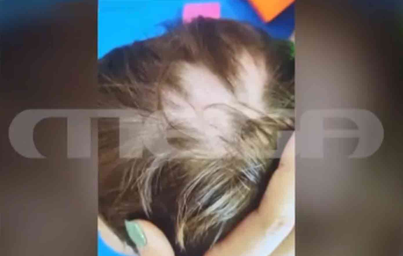 Ανατριχιαστική φωτογραφία από το 2χρονο αγοράκι που του ξερίζωσαν τα μαλλιά σε βρεφονηπιακό σταθμό στον Αυλώνα