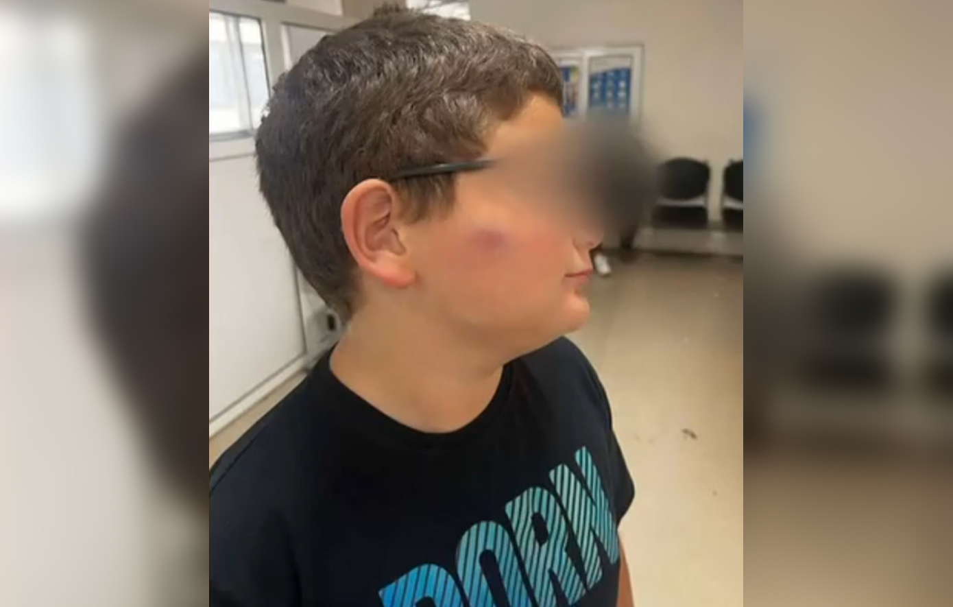Θύμα άγριου bullying έπεσε 11χρονος στη Θεσσαλονίκη &#8211; Συμμαθητές του επιτέθηκαν στο προαύλιο του σχολείου