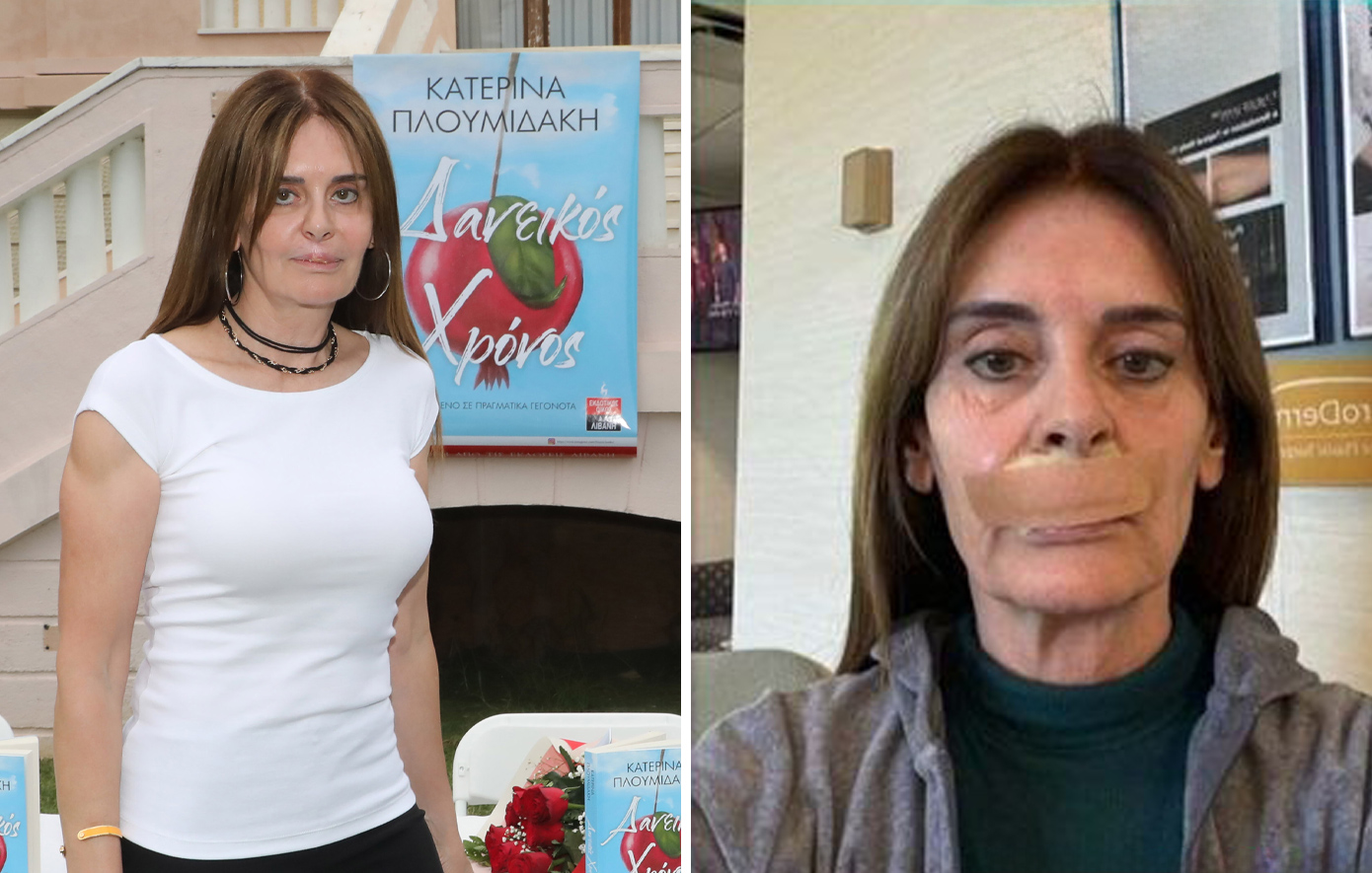 Κατερίνα Πλουμιδάκη για το λάθος του χειρουργού της: «Έκανα την 21η επέμβαση &#8211; Πήραν λίπος από τον γοφό μου»