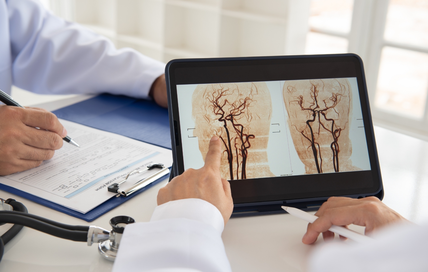 Εγκεφαλικό και ανεύρυσμα: Ποια είναι η διαφορά