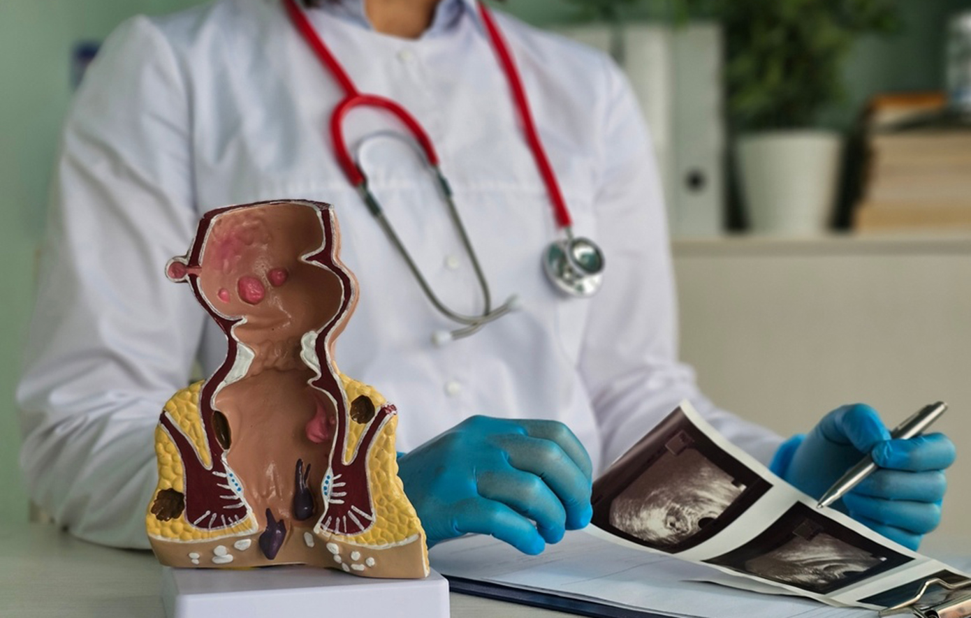 Εκκολπωμάτωση παχέος εντέρου: Η «σιωπηλή» πάθηση που αυξάνεται με την ηλικία