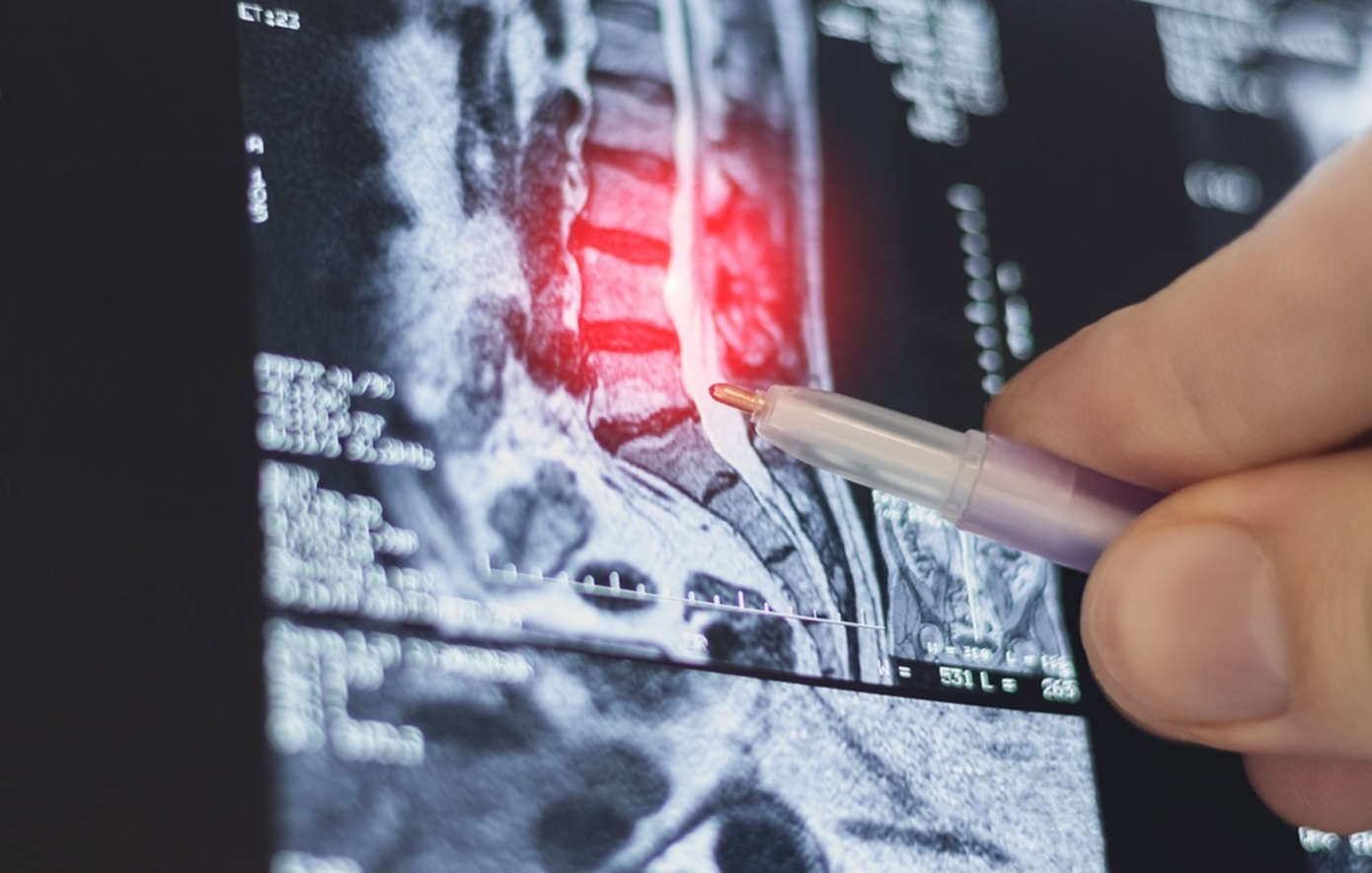 Η διέγερση νωτιαίου μυελού ως σύγχρονη λύση για τον χρόνιο πόνο