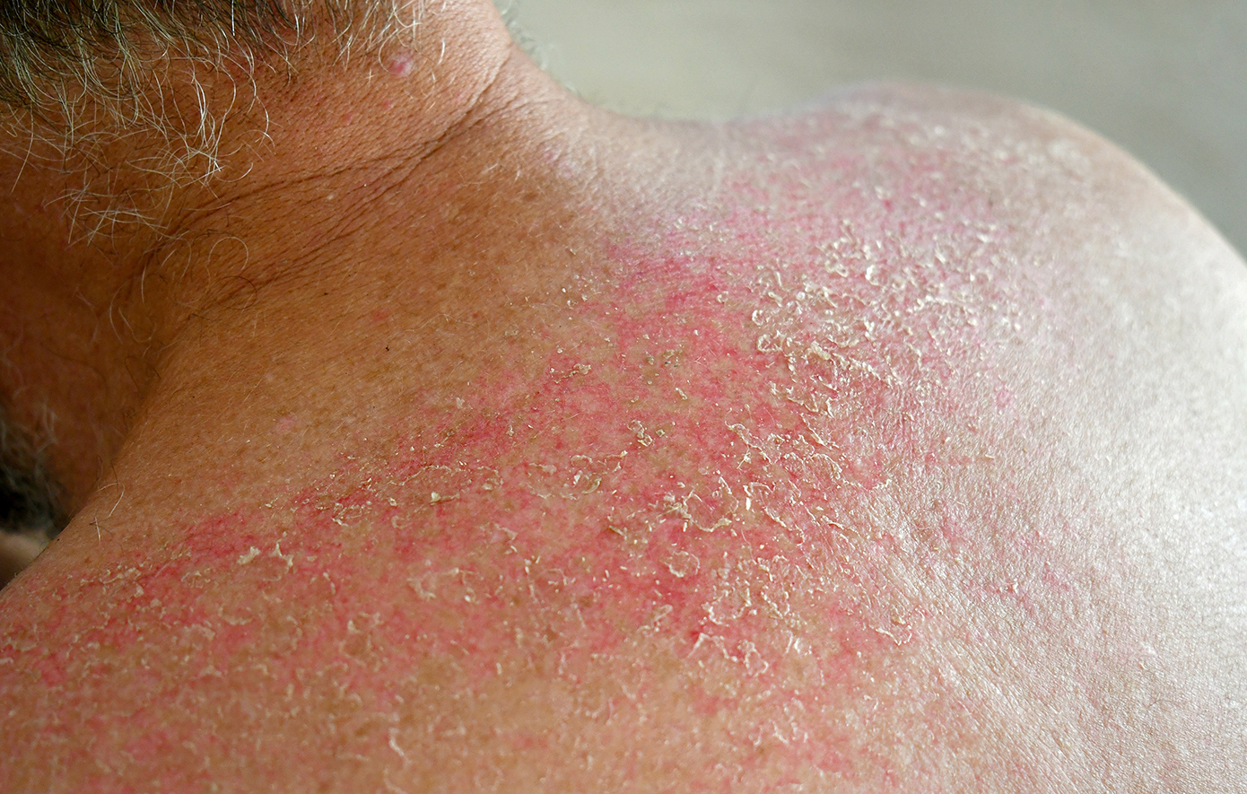 Eπιστροφή της λέπρας στην Ρουμανία μετά από 44 χρόνια: Τρόμος σε σπα με δυο μασέρ