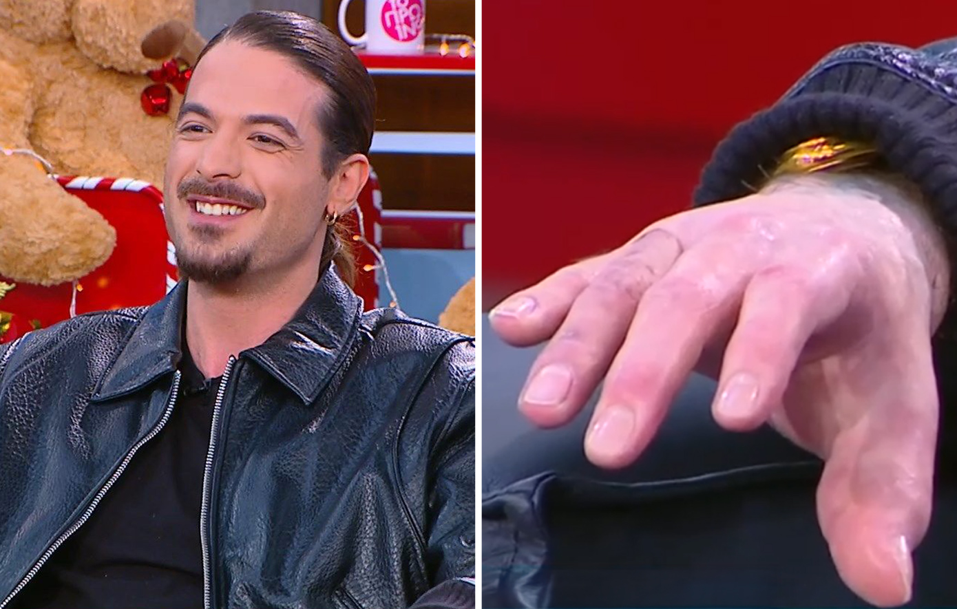 Ο Άρης Μουγκοπέτρος δείχνει τα δάχτυλά του μετά το ατύχημα με την κροτίδα &#8211; «Θα επιστρέψω στη δουλειά μου»