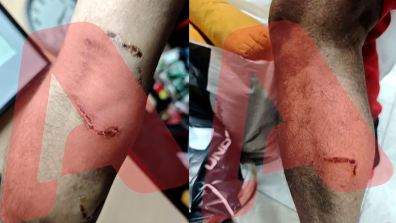 Ομόνοια: Έδωσε εντολή στο πίτμπουλ του να επιτεθεί σε 30χρονο για να τον ληστέψει &#8211; Σοκάρει η μαρτυρία του θύματος