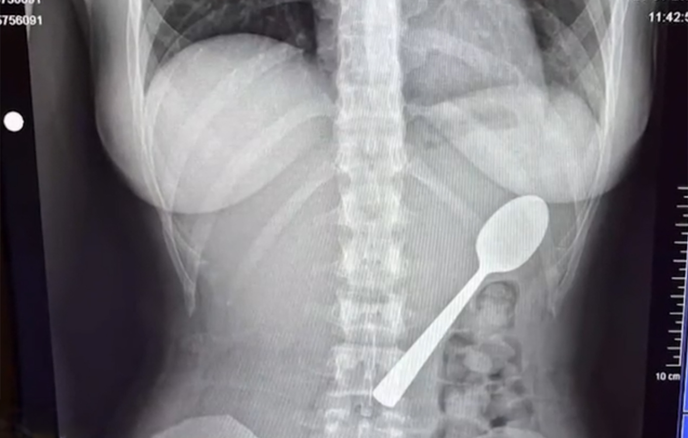 Κατάπιε κουτάλι 17 εκατοστών και κόλλησε στο στήθος της &#8211; Πήγε στα επείγοντα γιατί της το είπαν στο ίντερνετ
