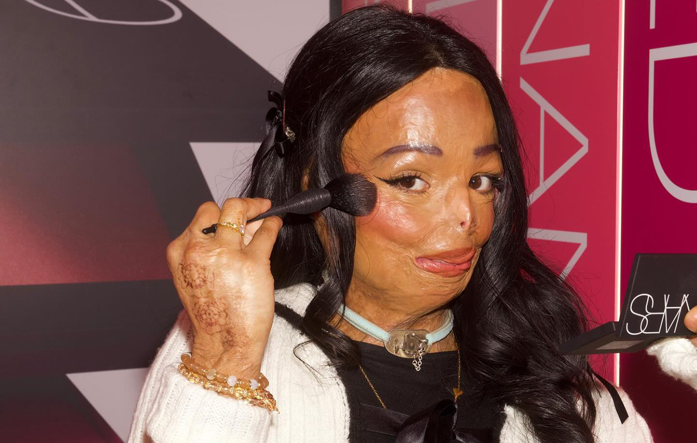 Τραγικό ατύχημα: Υπέστη εγκαύματα τρίτου βαθμού μετά τη χρήση σαμπουάν για ψείρες – «Χρειάστηκε να μάθω ξανά να περπατώ, να μιλάω και να τρώω»