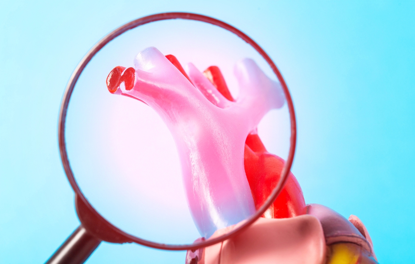 Φραγμένες αρτηρίες: Συμπτώματα και θεραπεία της αθηροσκλήρωσης