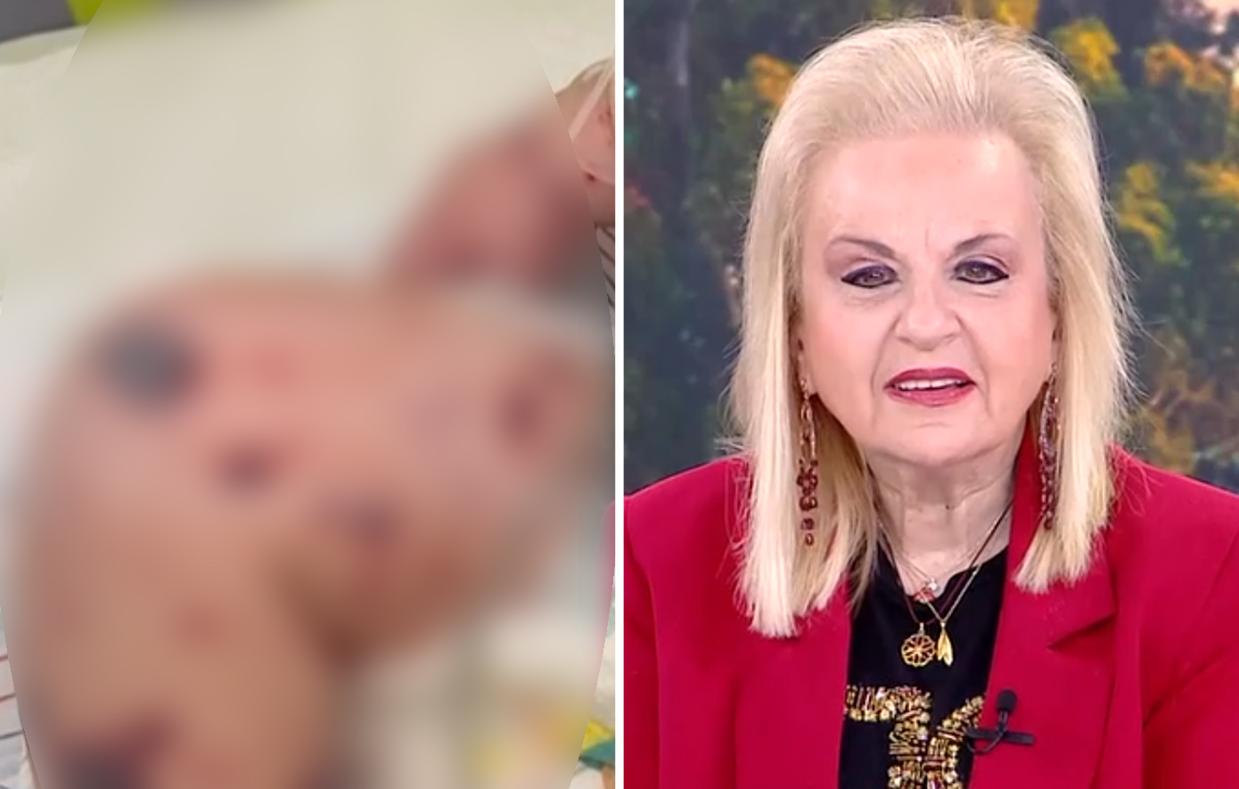 Παγώνη για το βρέφος στη Ζάκυνθο: Δεν έχουμε θανάτους από ιογενή μηνιγγίτιδα – Από φωτογραφίες δεν μπορούμε να βγάζουμε διαγνώσεις