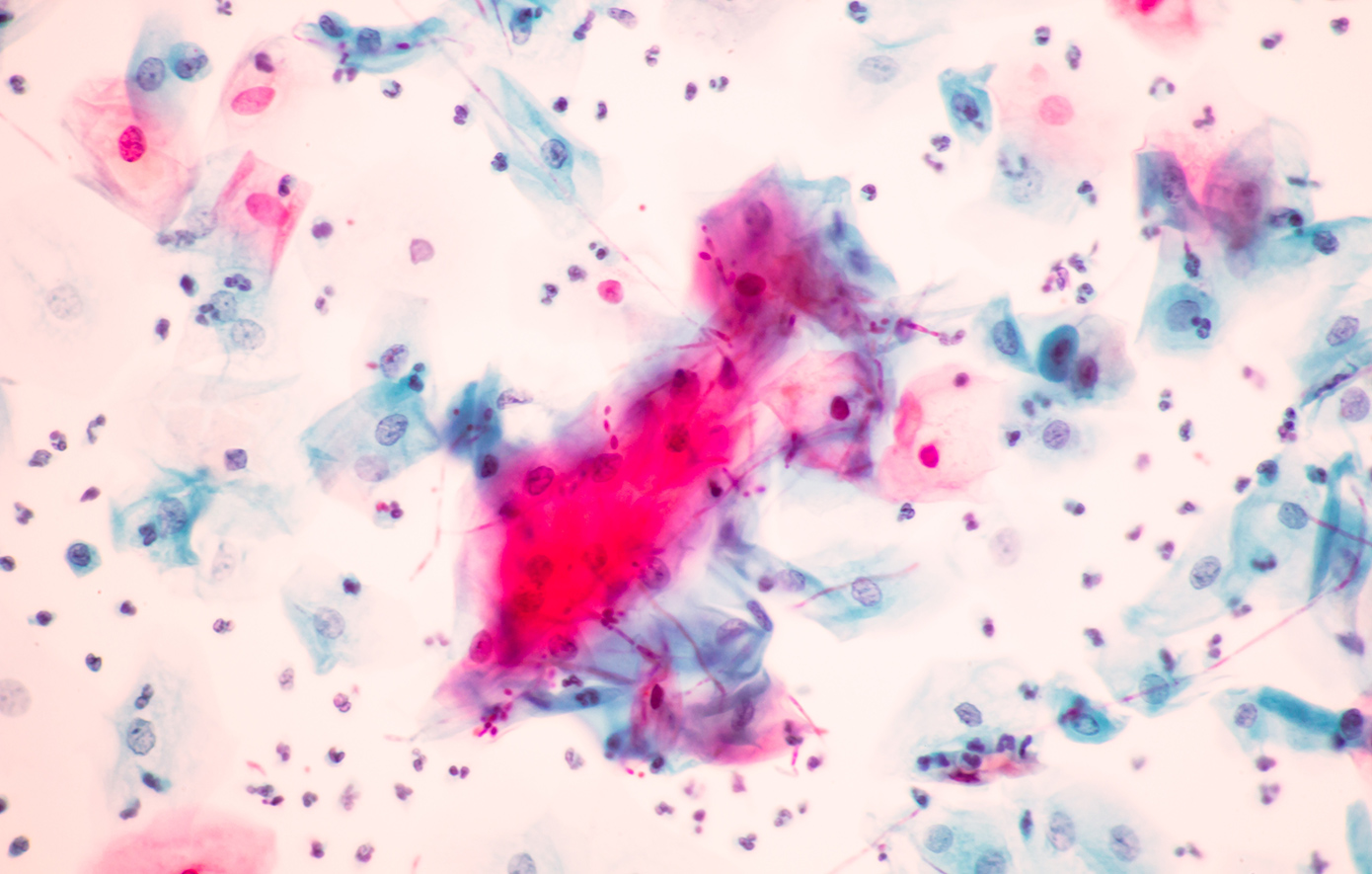 Ανησυχία για τα «superbugs» στη Νέα Υόρκη – Αύξηση των κρουσμάτων του Candida auris και προειδοποιήσεις ειδικών για την ανθεκτικότητα στα αντιβιοτικά