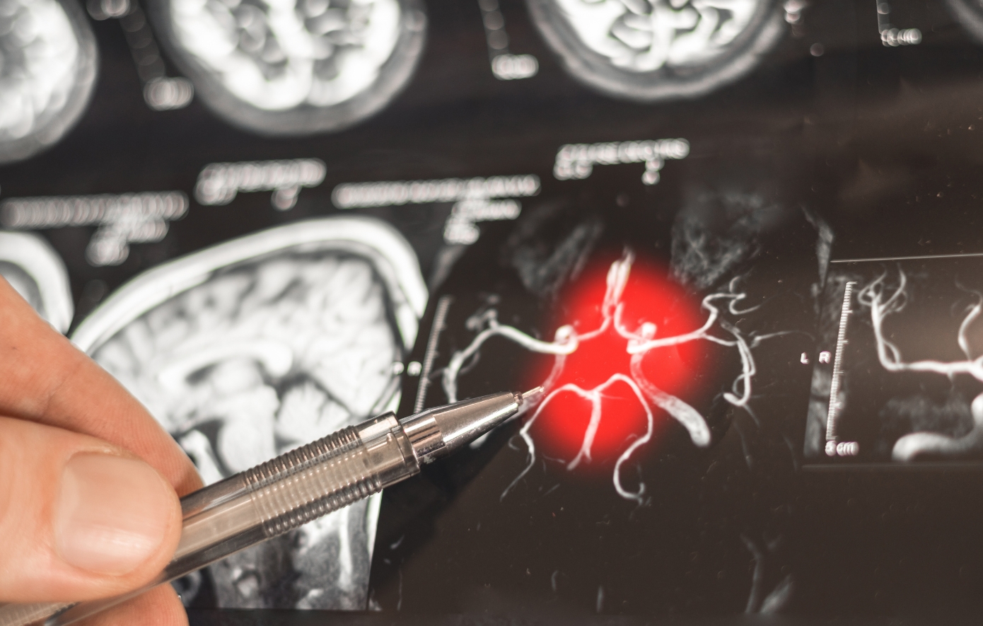 Εργαλείο AI προβλέπει το Αλτσχάιμερ με ακρίβεια 93%