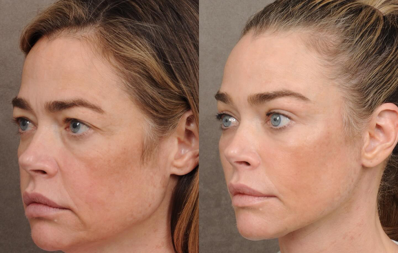 H ηθοποιός Ντενίζ Ρίτσαρντς δείχνει το πριν και το μετά από το λίφτινγκ &#8211; Δείτε τις διαφορές στο πρόσωπό της