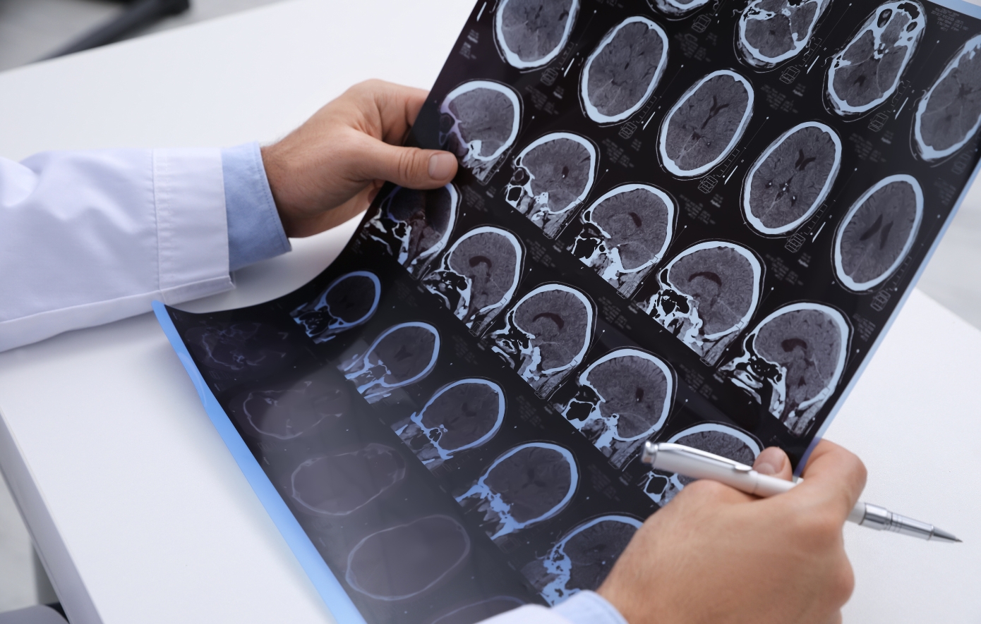 Πολλαπλή Σκλήρυνση: Η νόσος με τα πολλά πρόσωπα