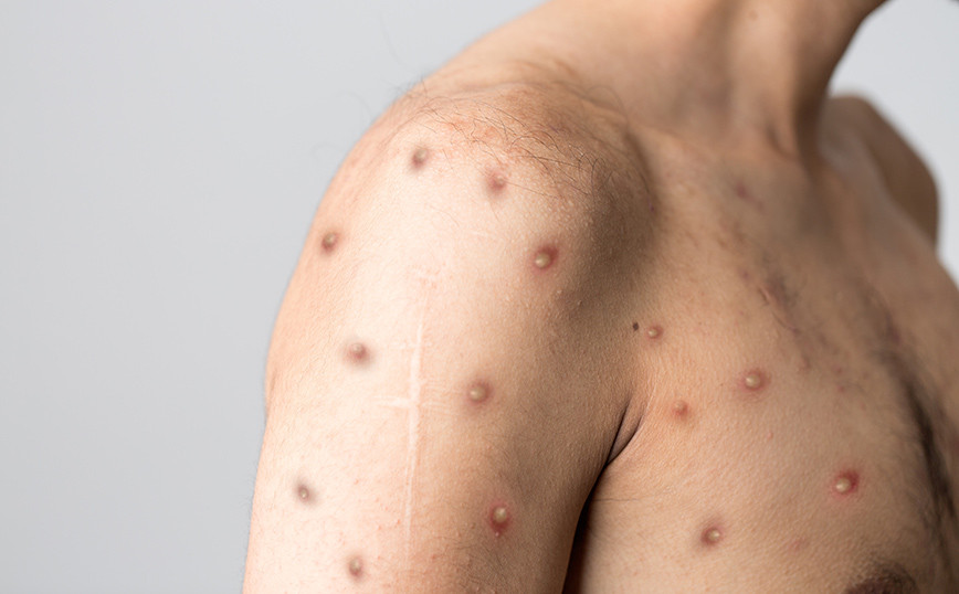 Monkey pox: The first woman was infected in Portugal