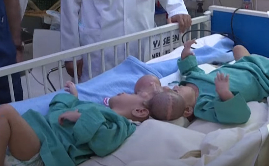 Saudi Arabia: Sophisticated operation to separate Siamese – It took 15 hours and 24 doctors
