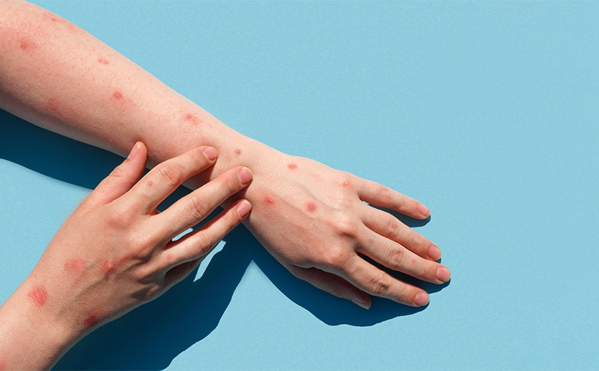 Denmark: First case of monkeypox in a woman