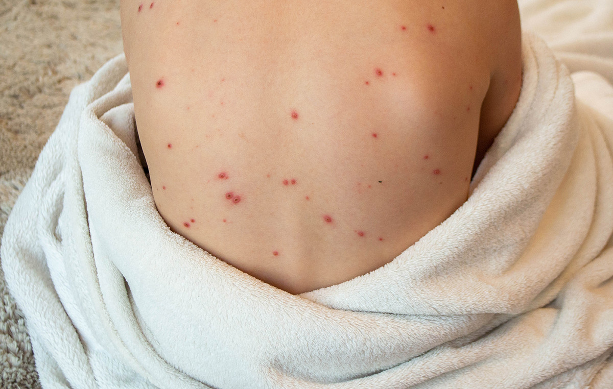 Measles makes ‘particularly dangerous return’: Concern for diseases that are spreading again – the UN warns