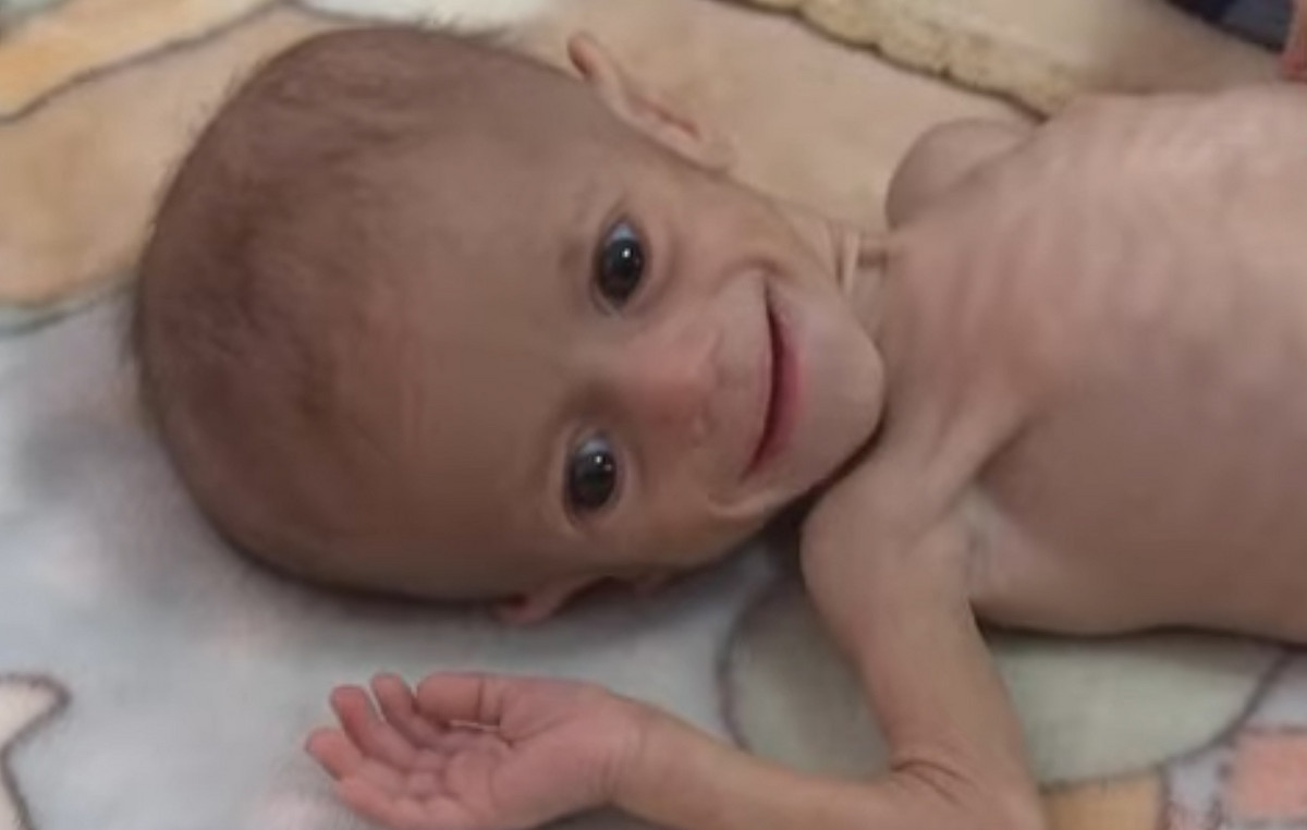 Little Sure Ascent Shocked the Planet: The girl born in the war and hunger is in danger of dying