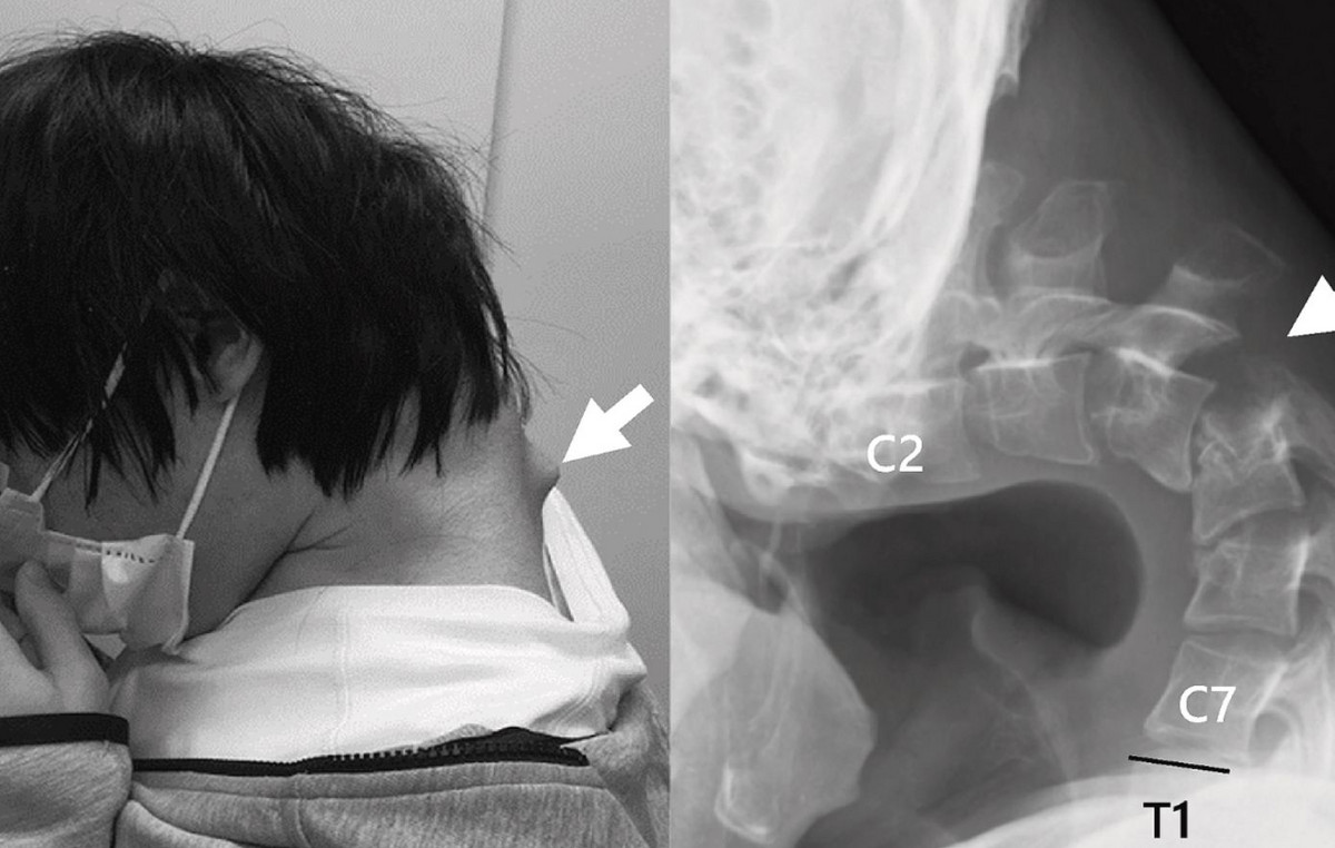The “fallen head syndrome”: Japanese “changed” his skeleton because he used his mobile too much