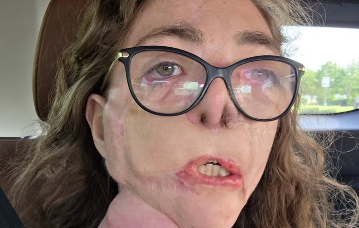 Woman deformed on the face after dog attack – see how it was after the incident and how they are today (hard pictures)