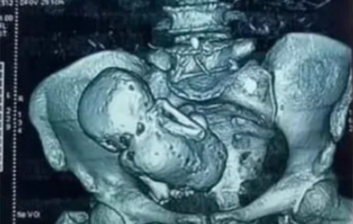 Pain in the middle was ‘rocky’ baby that has been pregnant for 40 years – its extremely rare condition Pain in the middle was ‘rocky’ baby that has been pregnant for 40 years – its extremely rare condition