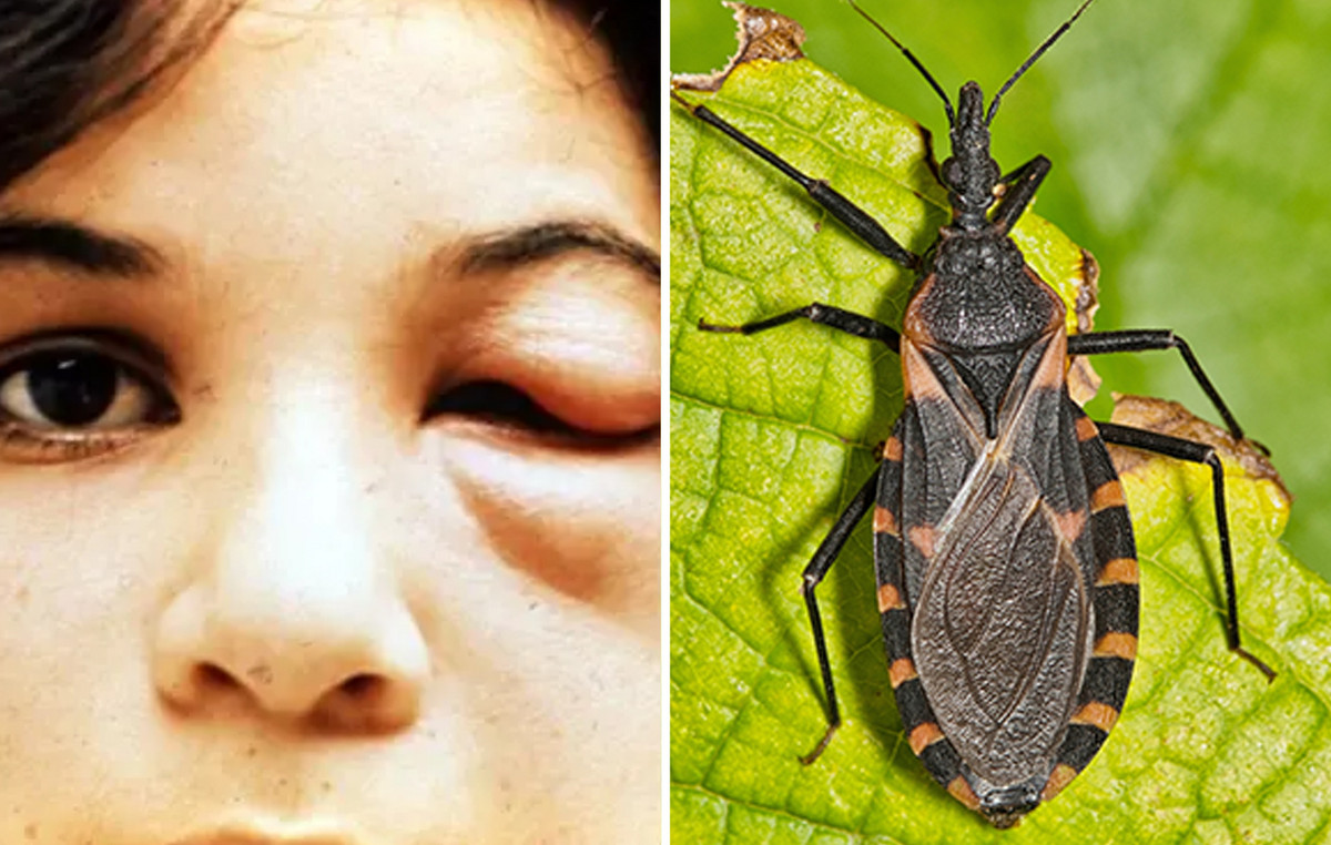 US alert for “kiss mites”: transmitting the teasing disease that can kill – what are the symptoms